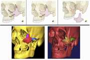 بازسازی خودکار تصاویر CT شکستگی های گونه با کاربرد در جراحی هدایت شده استخوان فک و صورت